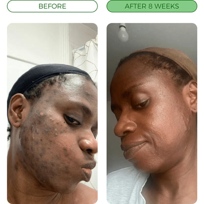 NAIA Turmeric Fade & Glow Bar shown in before and after images highlighting skin brightening and fading effects.